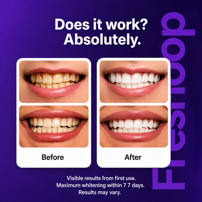 Freshoop Purple Teeth Whitening Strips™