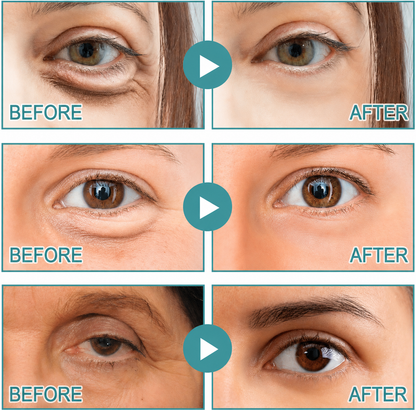 Freshoop | Dissolving Microneedle Eye Patches