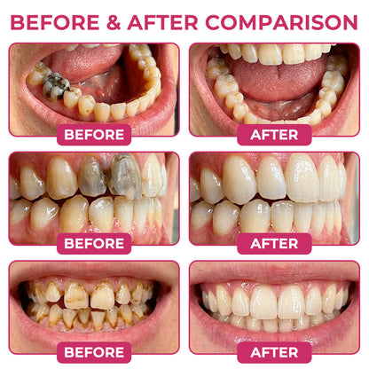 Clinclii Cavity-Repair Natural Enamel Filling Gel